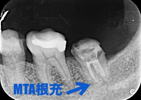 治療中 | 市ヶ谷・歯医者