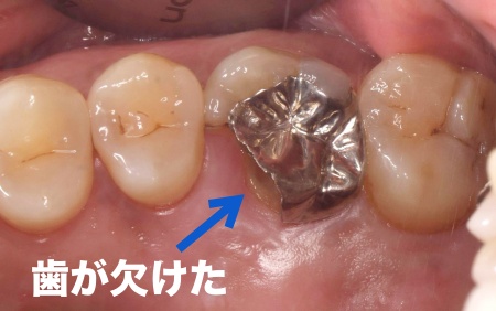 治療前 | 市ヶ谷・歯医者