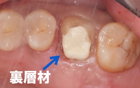 治療中 | 市ヶ谷・歯医者