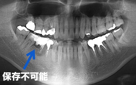 治療前 | 市ヶ谷・歯医者
